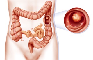 condilom intestinal