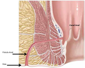 O que causa fistula anal?